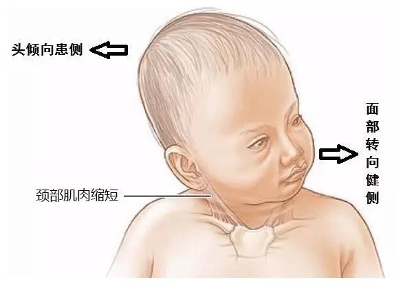 八个月宝宝斜颈怎么办？全方位解析应对之策